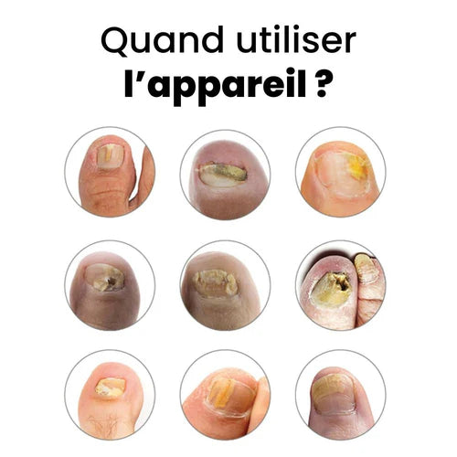 Appareil Anti-Mycose